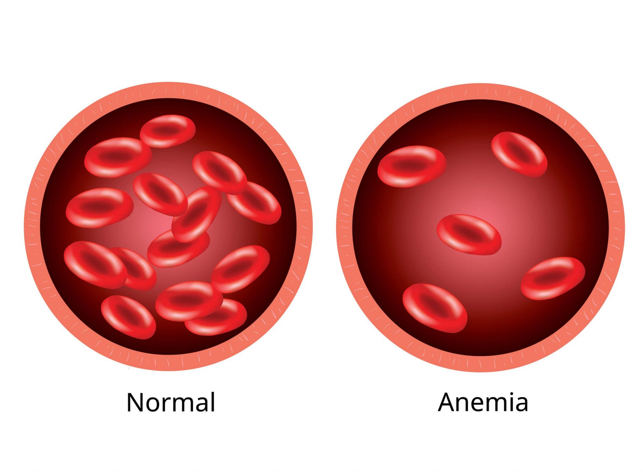 Анемия - причины и лечение. Альфамед