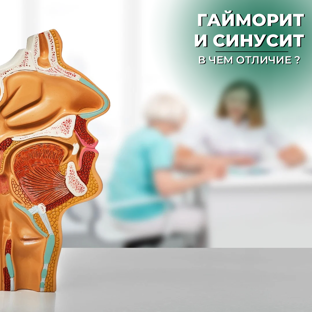 Гайморит и синусит - в чем отличие? - alphamed.by